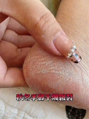 20💰出头的手足干裂膏真的爱惨了！